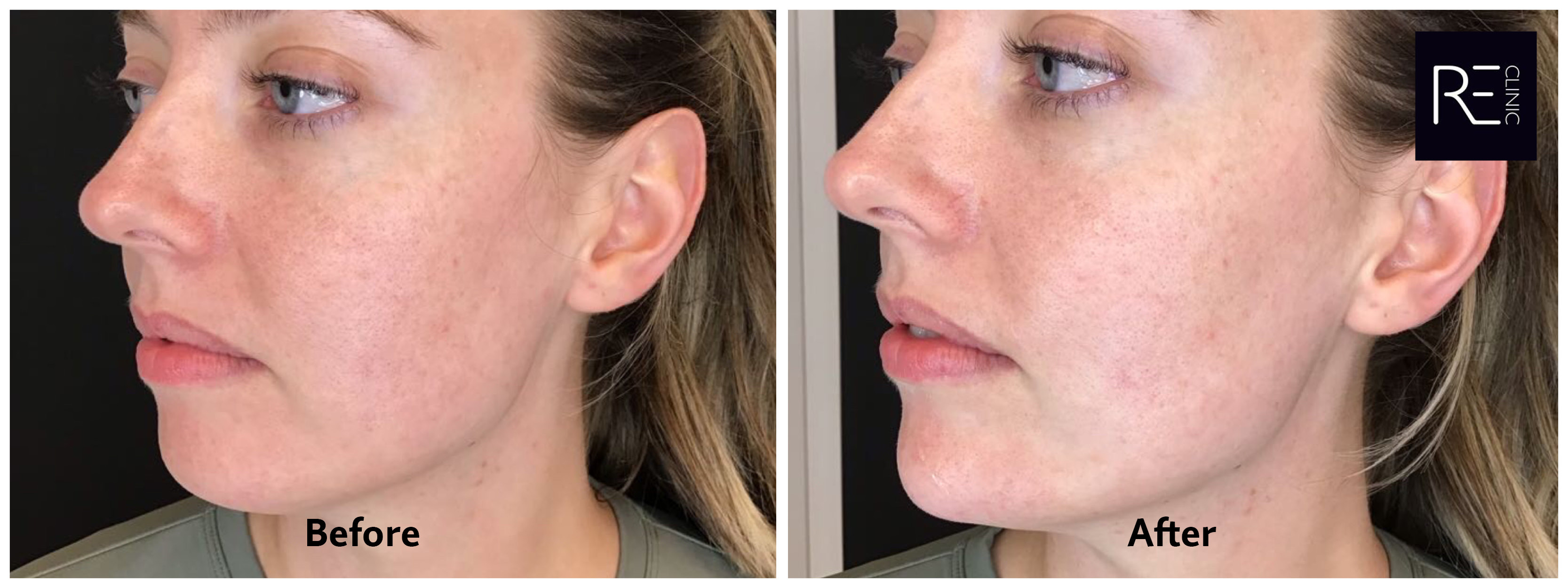 Chin Fillers Before and After at REclinic
