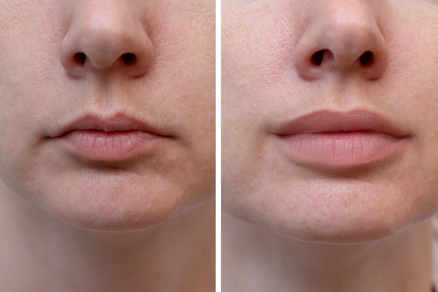 Fuller lips with dermal fillers