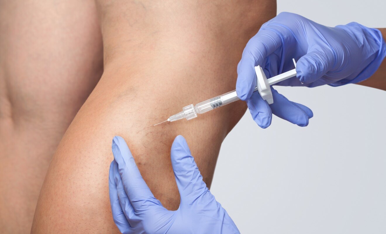Microsclerotherapy 1