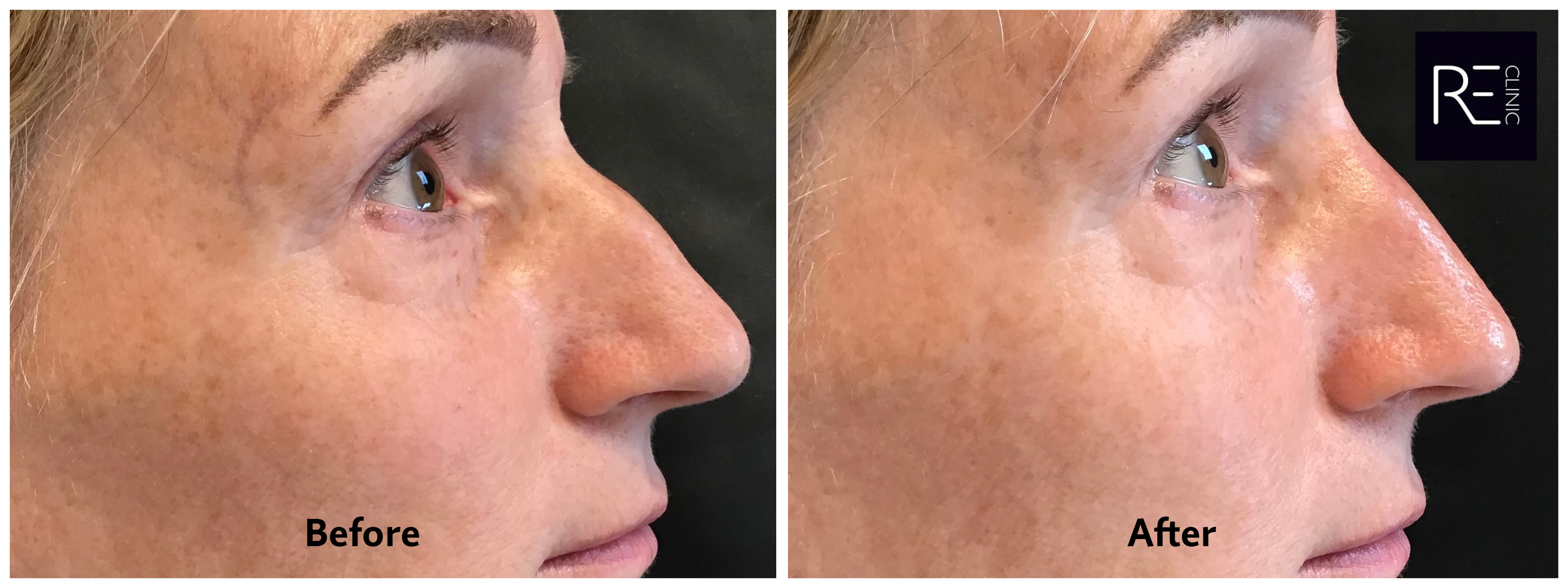 Non-surgical Rhinoplasty (nose job) at REclinic
