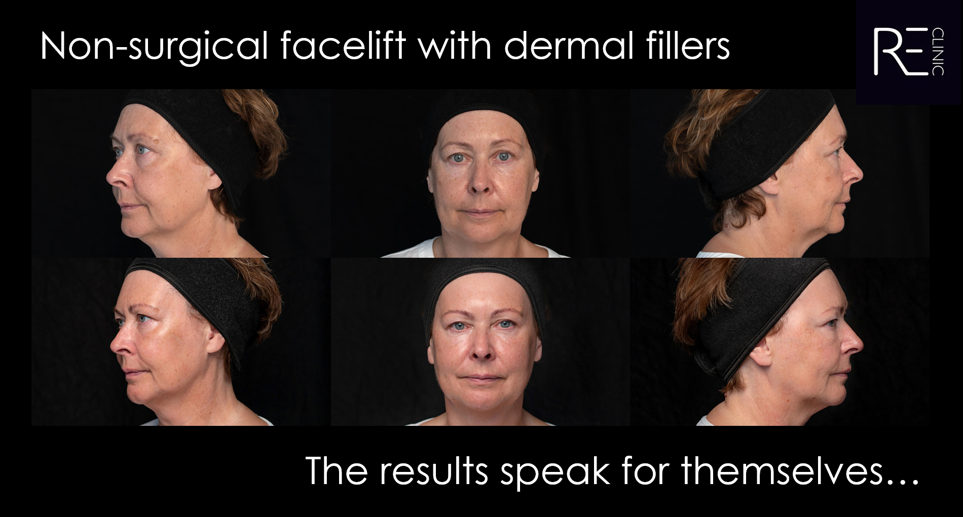Non surgical facelift with dermal fillers