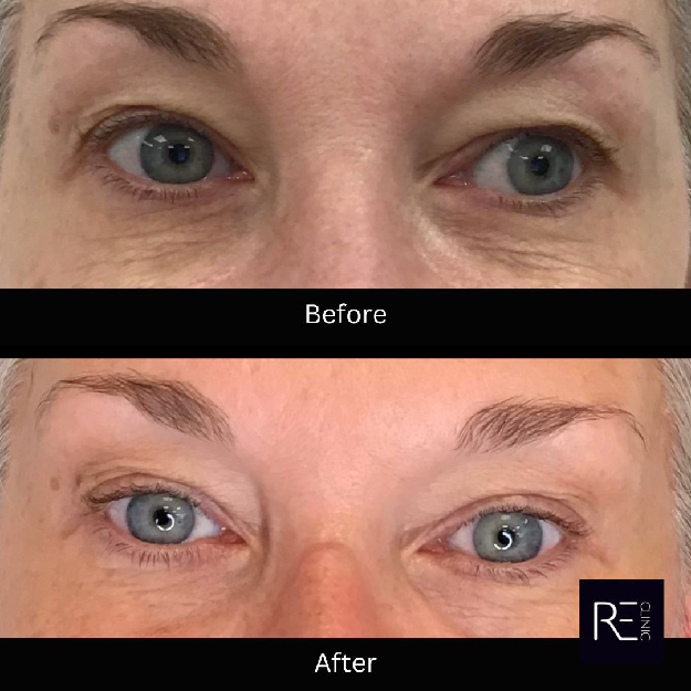Secret RF before and after eyes