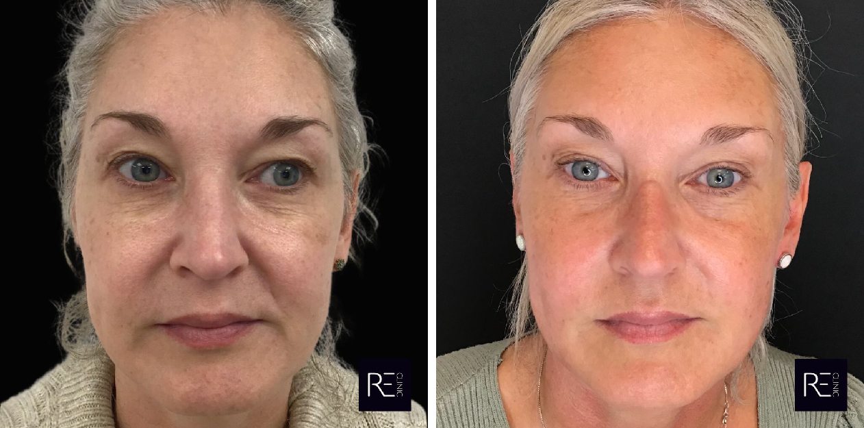 Secref RF Before and After full face