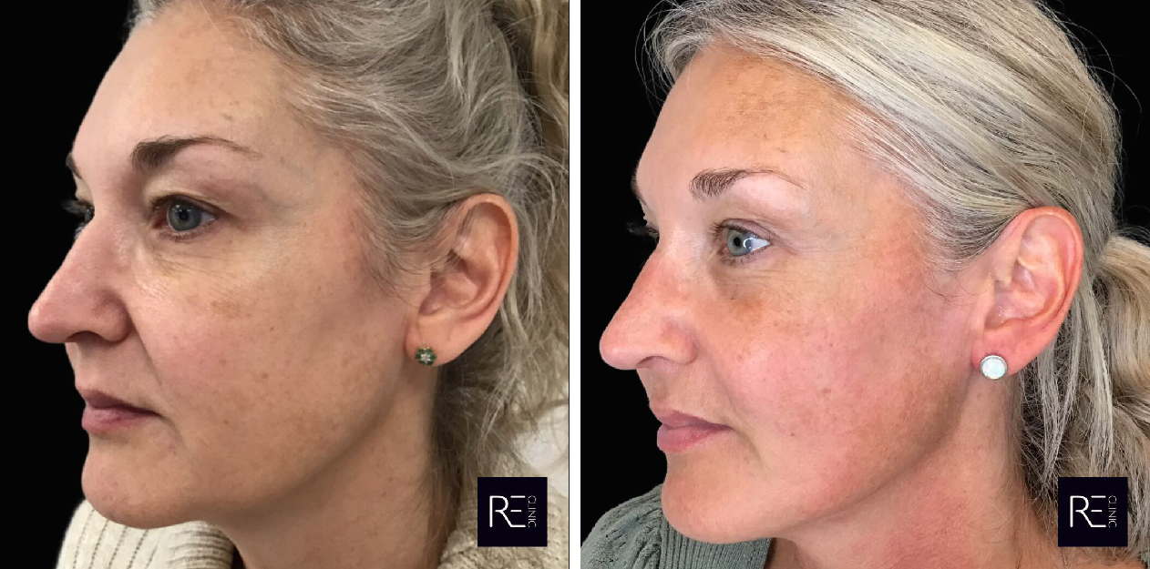 Secret RF before and after side face
