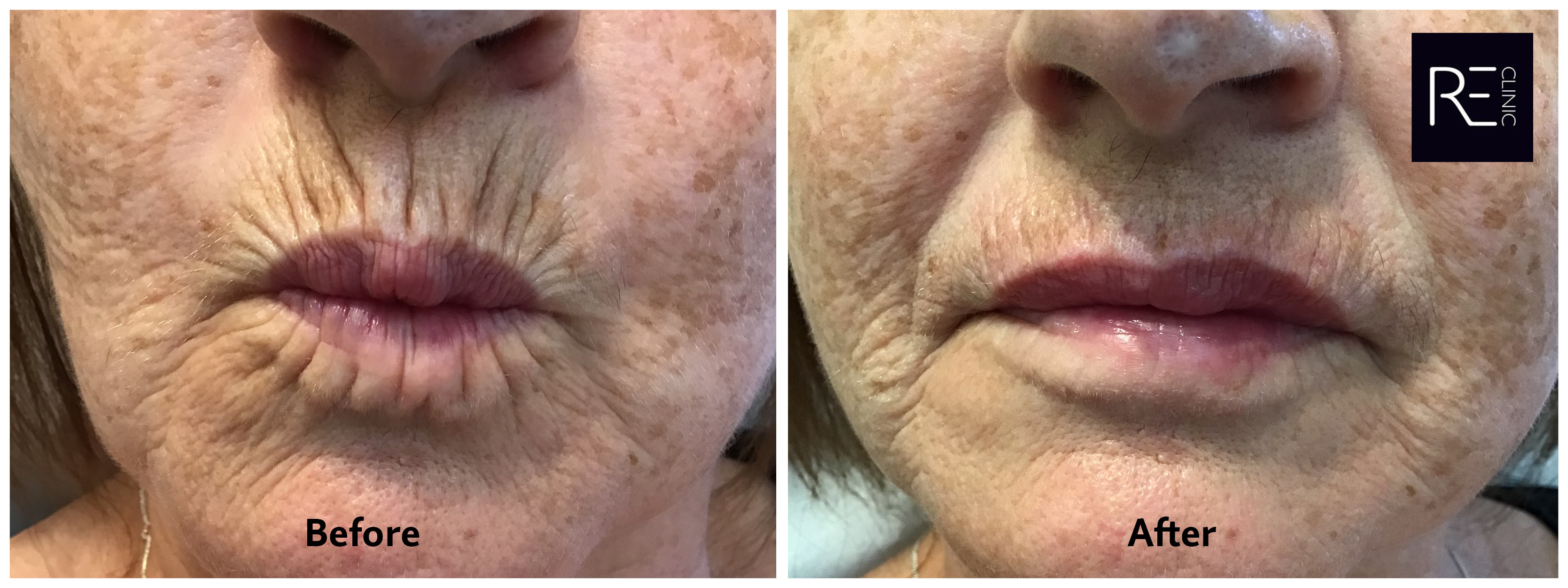 Smokers Lines before and after - treated with Botox and Filler at REclinic
