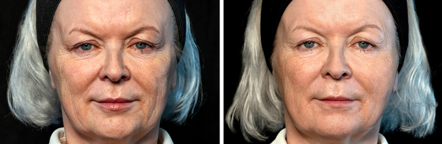 before and after facelift with fillers - front facing