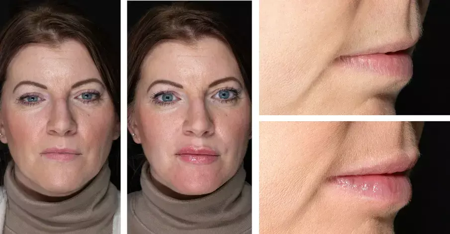 Before and after lip filler treatment using 'fencing' technique