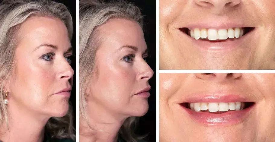 Before and after lip filler treatment using the 'fencing' technique