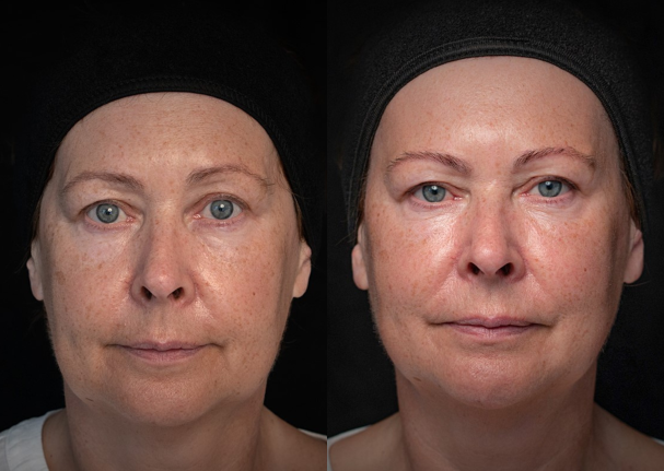 patient Gillian before and after filler treatment