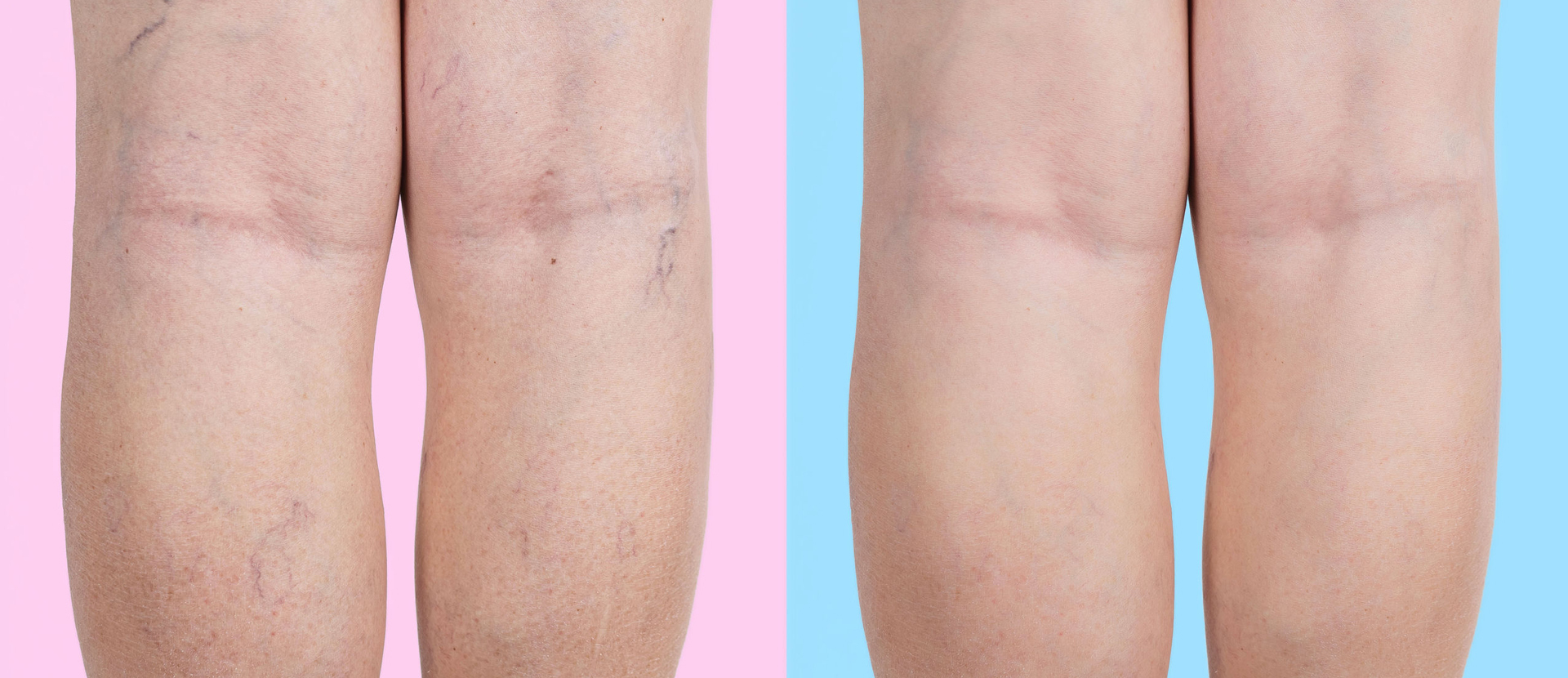 Thread Veins before and after treatment